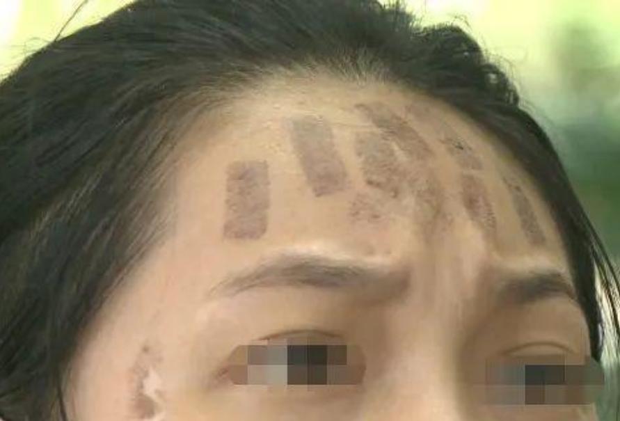 成都光子嫩膚價(jià)格，科技重塑肌膚之美